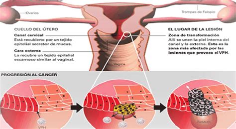 Hola doctora, tengo el virus del papiloma, mi utero tiene varias heridas, por fuera no tengo nada. CÁNCER DE CUELLO UTERINO