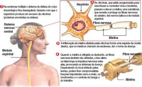 A em é uma doença crônica, progressiva e autoimune, na qual o sistema. Esclerose múltipla - Só Biologia