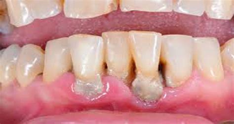 The middle of the canker sore may appear white, gray, or yellow, and the edges are red. THE DENTIST ADVISES - ORAL CANCER - Guyana Chronicle