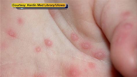 Serious complications from hand, foot, and mouth disease are rare. University of Illinois reports 60 cases of hand, foot and ...