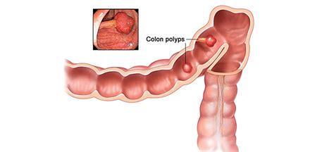 General abdominal discomfort (frequent gas pains, bloating, or cramps) that can be confused. What are the Symptoms of Colorectal Cancer? - Neoalta ...