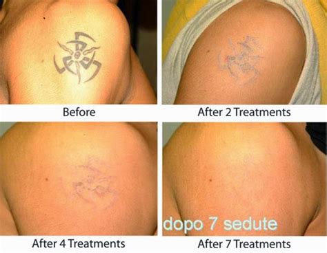 May, 2011 tattoo removal programs in los angeles county: DESCUBIERTA UNA CREMA QUE BORRA LOS TATUAJES | Belagoria ...