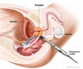 Bone pain (due to spread) symptoms from compression of the spine Symptoms of prostate cancer so you can make changes now!