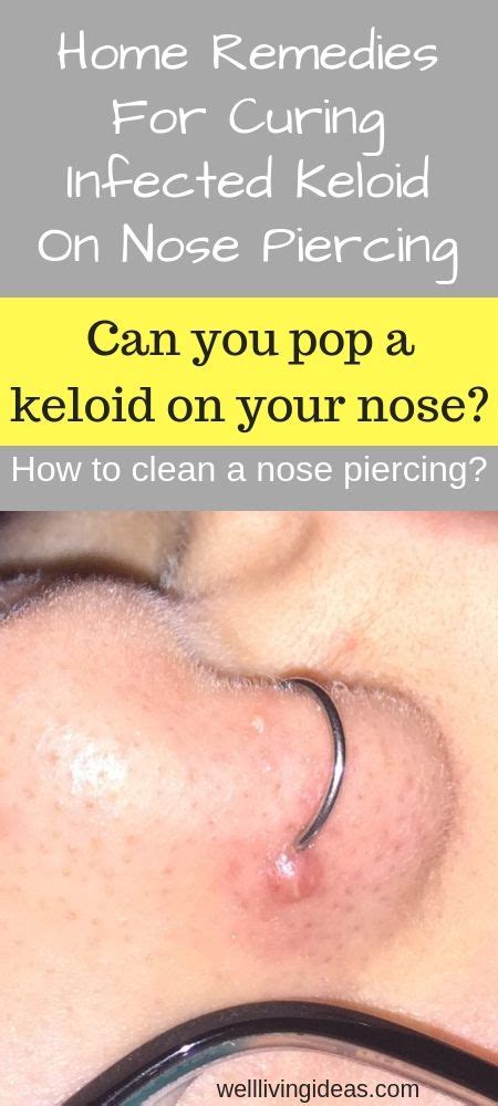 See full list on arraydict.com 10 Natural Home Remedies For Curing Infected Keloid On ...