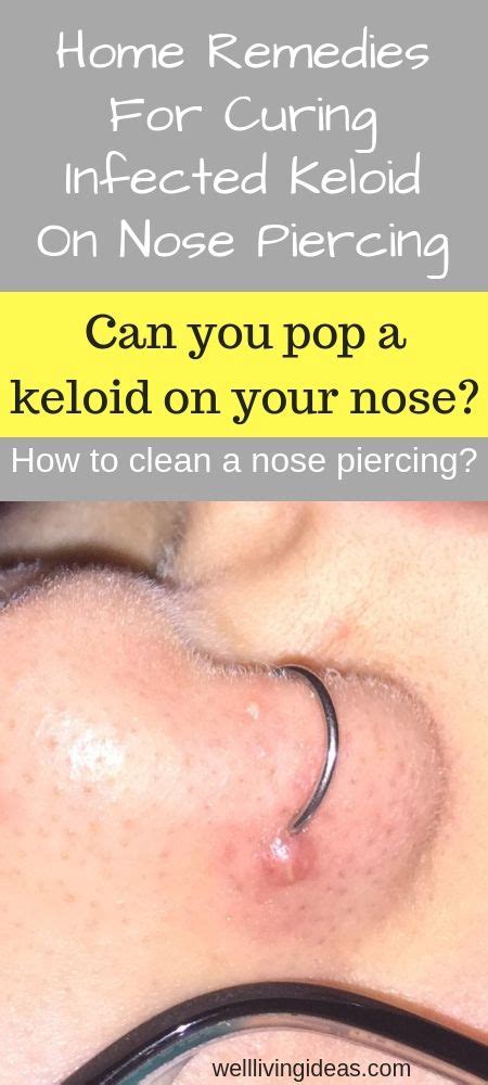 Check spelling or type a new query. 10 Natural Home Remedies For Curing Infected Keloid On ...