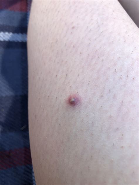 I need to get rid of them! Ingrown hair on my leg AH : popping