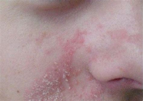 Crosta lattea: le squame sulla pelle dei bambini - Siamo Mamme