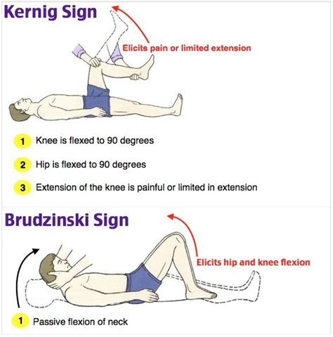 Accuracy of kernig's sign brudzinski's sign. Image result for kernig and brudzinski's signs | Pediatric ...