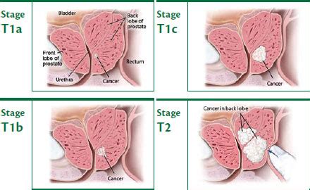 The main airway of the lung (main bronchus) Stage 4 Prostate Cancer