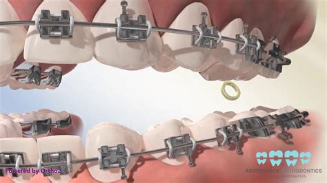 Different types of crossbites what causes a crossbite? Posterior Crossbite Elastics - YouTube