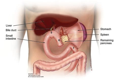 Men have a slightly higher likelihood of developing pancreatic cancer than women, which may partly result from increased tobacco use in men. [Cephalic duodenopancreatectomy with pyloric preservation ...