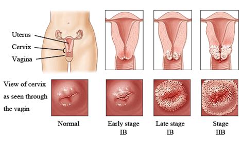 Tumor otak adalah kumpulan, atau massa, sel abnormal di otak. 4 Gejala Awal Kanker Serviks - Agarillus Series