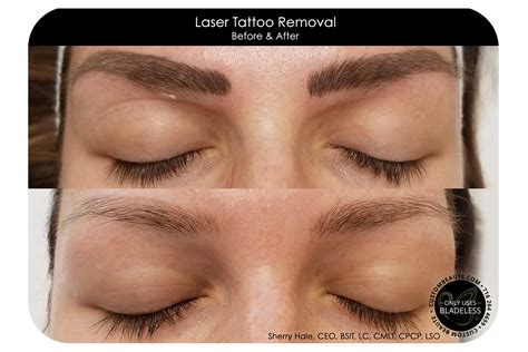 During the laser tattoo removal procedure, highly concentrated beams of light are delivered to the ink of the tattoo and, over time, fade its color. Laser Tattoo Removal in Amherst, Buffalo and Western NY