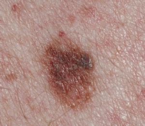 Check spelling or type a new query. Cancerous Moles | Warts Mole Removal