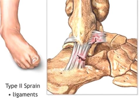 A sprain is a stretch or tear in a ligament.ligaments are bands of fibrous tissue that connect bones to bones at joints. Torn Ankle Ligament - Nanoori Hospital