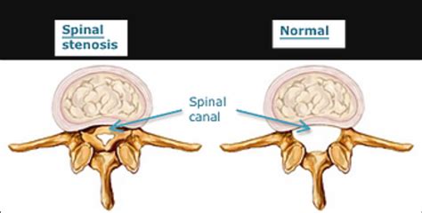 A hard time standing or walking. Spinal Stenosis - Surrey Orthopaedic Clinic