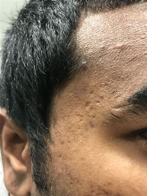 Guys please look into this Scar type and treatments and please provide ...