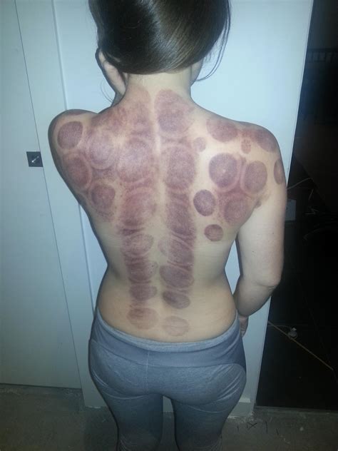 Qi is the free flow of vital energy circulating through the body and the world around. This is my SO's back after a Chinese "cupping" massage ...