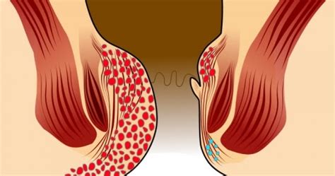 Langsung saya berdehem dan meludah lagi untuk memastikan apakah masih keluar dari mulut saya lagi apa tidak, tapi tidak keluar darah lagi, dok. Sakit Dan Perih Keluar Darah Dari Anus - Obat Herbal Ampuh