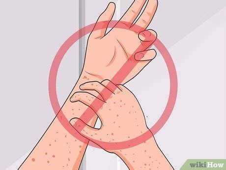 How to prevent chickenpox from spreading. 3 Cara untuk Mengobati Cacar Air - wikiHow