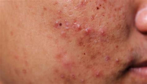 3 ways to reduce scars on face! Selain Pudarkan Parut Jerawat, Makanan 'Superpower' Ini ...