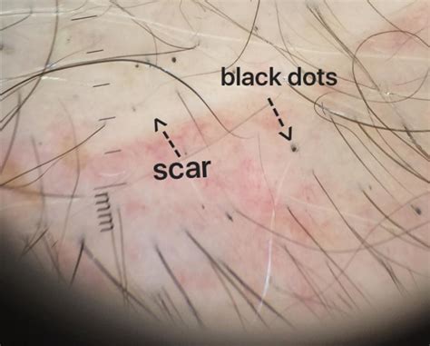 You will likely have a red and intensely itchy rash. Can alopecia areata occur at the location of a hair ...