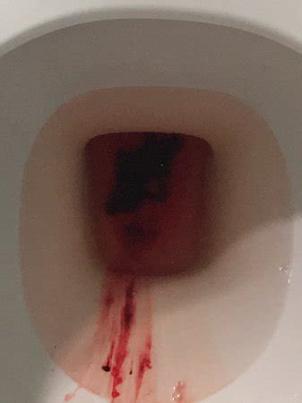 That flash of red or brown can instantly conjure up fears of miscarriage—but bleeding and spotting during pregnancy is more common than you'd think, and. *graphic image* miscarriage? Implantation bleeding ...