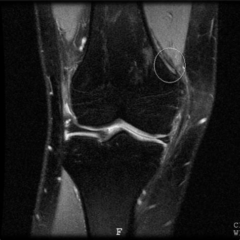 The origin of this tissue is controversial. Pellegrini-Stieda Syndrome | Eurorad