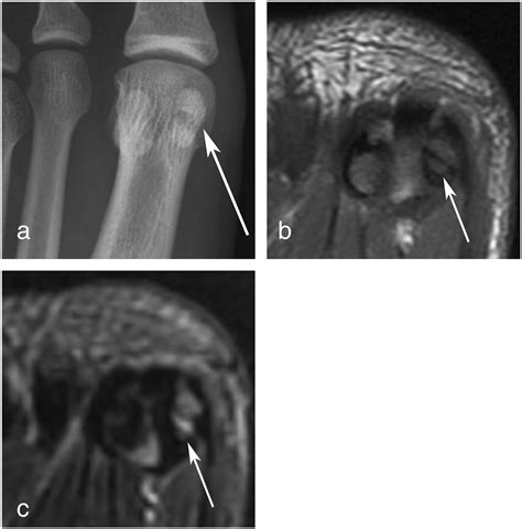 Turf toe can range from a mild injury with only minor ligament damage to a chronic injury involving inflammation of the joint capsule and progressive cartilage formation and. Turf toe and sesamoiditis: what the radiologist needs to ...