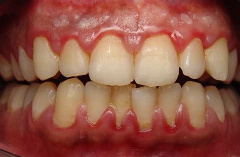Can you tell if you have cancer? Gum Disease - How can I tell? - Cranbourne North Dental