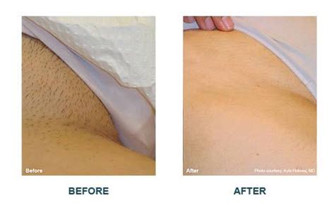 While, in bikini wax, hair in the pubic area is not waxed. Laser Hair Removal - before and after photo - Platinum ...