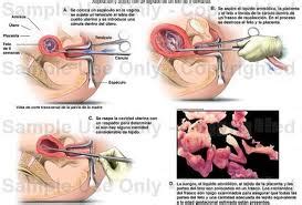 El término aborto espontáneo sugiere qué algo se hizo mal mientras se estaba embarazada. anatomia: LEGRADO UTERINO