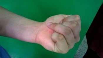 Flexor tendons are prone to laceration and rupture with injuries commonly occurring in association with manual labor, athletics, and in the setting of stress on the fdp tendon repair at 6 to 8 weeks should occur slowly with a focus on arom, avoidance of joint stiffness, and management of scar pain and. FLEXOR TENDON RUPTURE