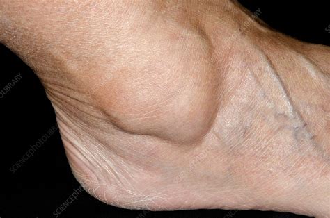 This is the place where several small ankle bones firstly, there is nothing like ganglion cyst home treatment, because it requires surgical treatment, and that too after a through evaluation by an. Ganglion over the ankle - Stock Image - C014/2748 ...