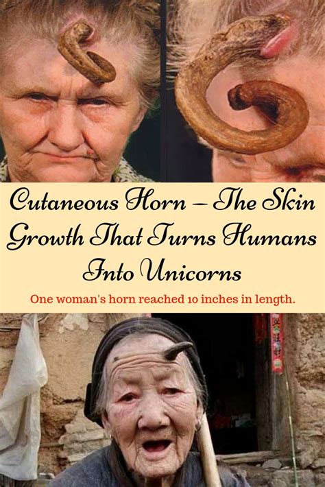 It is composed of compacted keratin (the same protein in nails). Cutaneous Horn — The Skin Growth That Turns Humans Into ...