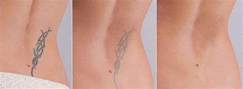 Some people can have a tattoo virtually disappear, whereas others may need to come back for five, 10 or even 20 sessions. Laser Tattoo Removal Salt Lake City | Steven Jepson, M.D