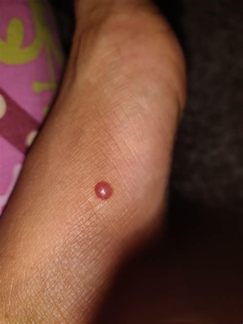 Most bug bites and stings are usually just uncomfortable. What kind of bug bite? Bites on legs turning to blisters ...