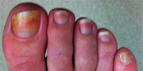Foot fungus is a general term for the many different fungal infections you could catch on your feet or toenails. Toe fungus @ re*be® Okoboji, Iowa (712)332-6001