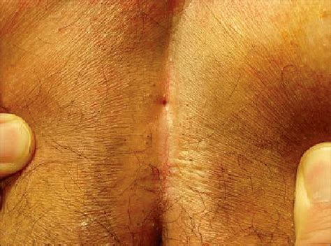 The exact cause of pilonidal cysts isn't clear. When the patient visited hospital, pilonidal sinus was ...