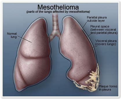 Pleural effusion can be treated to relieve patients' symptoms. Mesothelioma Cancer cause by Asbestos Exposure - Echague ...