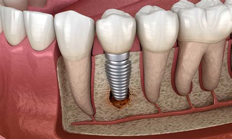 Can a loose crown be refitted? Signs of dental implant failure | Omega Dental Houston TX