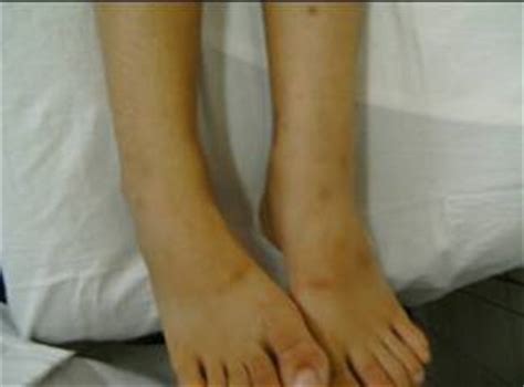Plachetele (trombocitele) sangvine sunt celule incol. Diabetes mellitus de tipo I y púrpura trombocitopénica ...