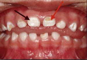 Calcium Deposits On Teeth How To Get Rid Of - TeethWalls