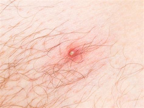 Although ingrown hairs can be. How to get rid of ingrown hairs - Business Insider