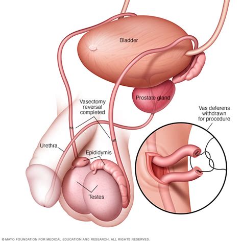 I had a vasectomy two days ago and feel pretty good (just a very minor pain on the left incision). Vasectomy reversal - Drugs.com