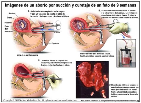 Se considera aborto;espontáneo a la pérdida;de un si el aborto es completo no requiere actuación médica, pero en caso de permanecer restos embrionarios deberá realizarse un legrado uterino. El Aborto